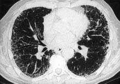 A presença de micronódulos finos mal definidos ou bases pulmonares poupadas sugerem Pneumonia de Hipersensibilidade.