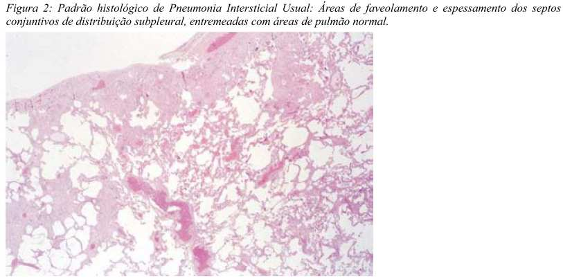 zonas fibróticas mostram heterogeneidade temporal, com áreas com colágeno denso e acelular entremeadas por focos fibroblásticos esparsos (Figura 3).