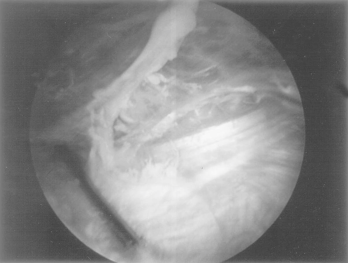 mento da cápsula articular posterior ao m-vasto medial que dirige-se do bordo medial da patela até a região do epicôndilo medial.
