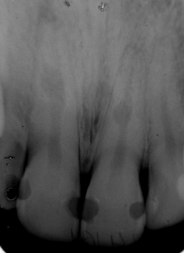 Revista de Endodontia Pesquisa e Ensino On Line - Ano 4, Número 7, Janeiro/Junho, 2008. 3 interna no terço médio da raiz dos dentes em questão (Figura 1).