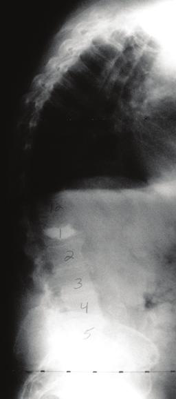 da cirurgia: 7 horas Tratamento cirúrgico: Fusão de T3 ao sacro com parafusos para fixação ilíaca Técnicas de osteotomia Smith-Peterson utilizadas nas