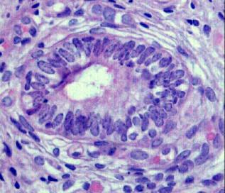 fibrose periglandular (seta).