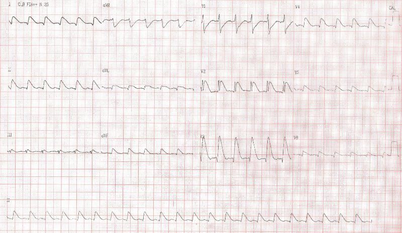 Figura 1 Eletrocardiograma de VTR, 27/02/2012, mostrando alterações