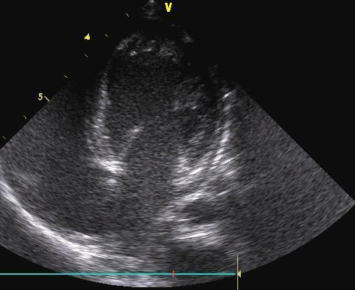 VE SÍSTOLE Figura 7 Exame Ecocardiográfico de 06/03/2012, de VTR, o ventrículo esquerdo (VE) em diástole.