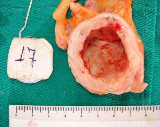 anatomopatológica da artéria ileocecocólica do animal número 17, demonstrando grande dilatação arterial (aneurisma), espessamento e irregularidade da parede (imagem à esquerda).