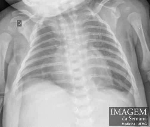 Imagem 02. Radiografia de tórax em AP após correção cirúrgica de hérnia diafragmática, sem anormalidades aparentes.