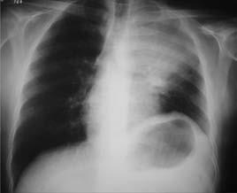 Fig. 2 Radiograma de tórax evidenciando massa pulmonar e atelectasia no pulmão esquerdo Discussão A artralgia é um sintoma relativamente comum, com ocorrência de aproximadamente 40%, chegando a