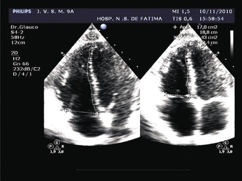 Santana GF, et al. O ecocardiograma no diagnóstico da displasia arritmogênica do ventrículo direito ao anel tricuspídeo contralateral, na telediástole e telessístole (Figura 4).
