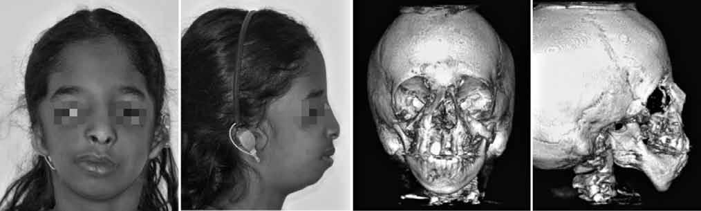 Síndrome de Treacher Collins: desafio na otimização do tratamento cirúrgico INTRODUÇÃO A síndrome de Treacher Collins, ou disostose mandibulofacial, é uma condição autossômica dominante, com