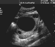 Quisto ovárico Endometrioma Até às 12 semanas visualização do