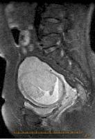 Estadiamento tumoral por RM Carcinoma