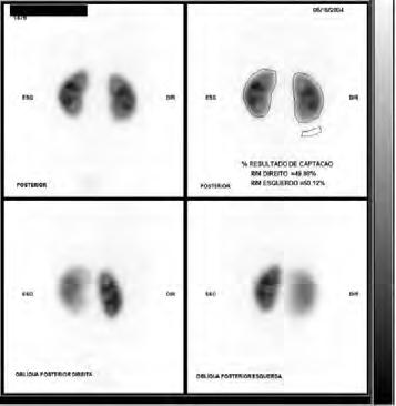 E) TÉCNICA O fármaco marcado é administrado e as imagens são adquiridas de 4 a 6 horas sua aplicação. Não há nenhum preparo do paciente para a realização deste exame.