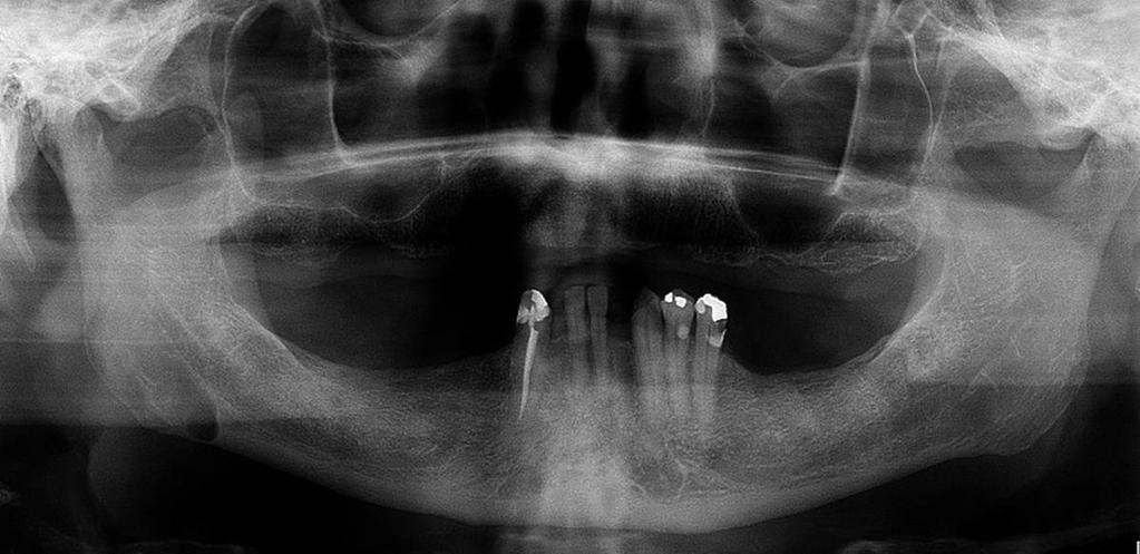 mandibular (Figura 1). As hipóteses diagnósticas foram: ameloblastoma unicístico, tumor queratocístico odontogênico e cisto residual.