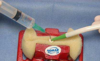 35 Remoção da smear layer Após o preparo apical dos dentes, os mesmos foram divididos em 2 grupos experimentais em função da remoção ou não da smear layer (n=8).