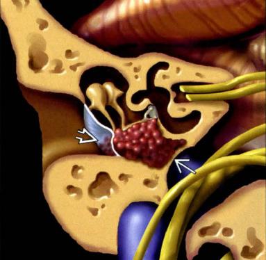 Paraganglioma, Glomo Timpânico São os tumores primários mais comuns da orelha media São tumores benignos originado dos corpos glomicos situados no promontório coclear É o segundo tumor mais frequente