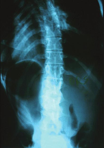 As vértebras neutras também são definidas na incidência AP em ortostatismo, sendo vértebras mais inclinadas, com rotação neutra, próximas ao eixo vertical ou linha sacral central.