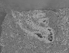 Patogenia Fosfolipase D Fator de permeabilidade Lesão endotelial Extravasamento do plasma Disseminação bacteriana Patogenia Fosfolipase D Hemólise Anemia hemolítica Sinais de choque