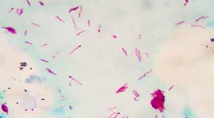 Guia de Procedimentos Técnicos: Baciloscopia em Hanseníase Bacilos Granulosos São bacilos que apresentam grandes falhas em sua parede celular, apresentando apenas pequenos pontos (grânulos) corados