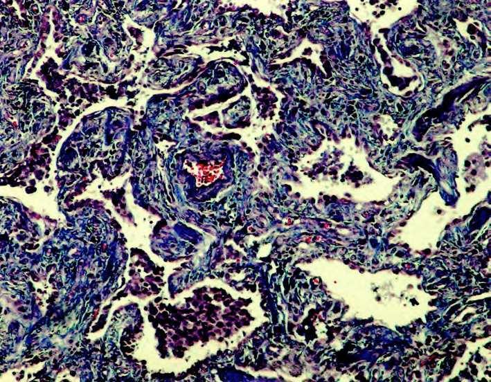 REVISTA PORTUGUESA DE PNEUMOLOGIA/CASO CLÍNICO Fig. 10 Tricrómico de Masson. Fibrose colagénea.