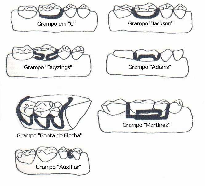 GRAMPOS DE RETENÇÃO Os grampos de retenção utilizados nos aparelhos ortodônticos removíveis foram planejados de acordo com as áreas retentivas existentes nas coroas dentárias.