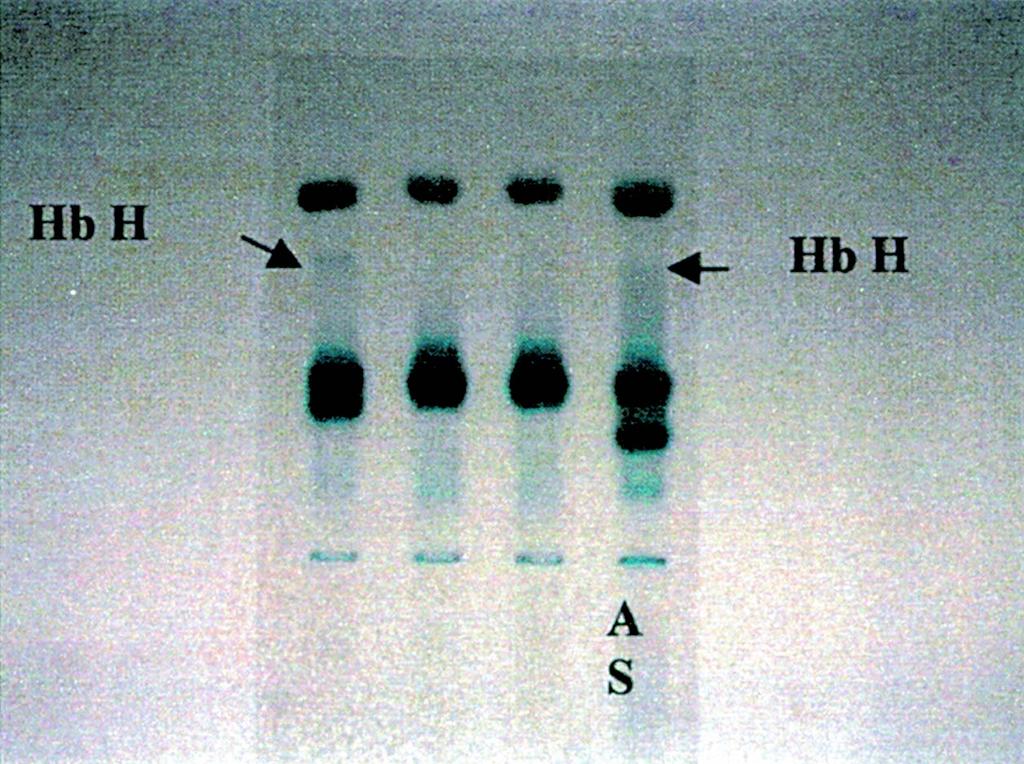 A B Figura 4. Eletroforese de hemoglobinas em Ph alcalino (A) e ácido (B) utilizando geis de agar da CELM.