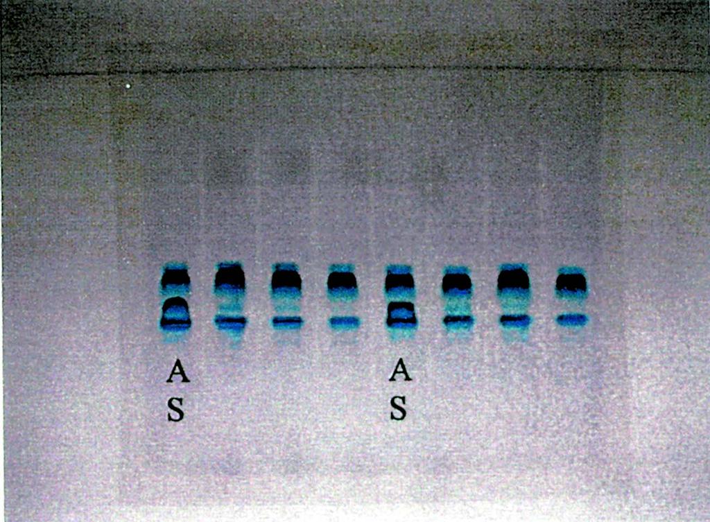 36% positiva não são resultados esperados para portadores de Hb AS. Esta ocorrência nos levou a suspeitar de possíveis interações com talassemia alfa ou ferropenia, que deveriam ser melhor avaliadas.