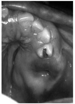 Os molares inferiores que estavam clinicamente ausentes encontravam-se retidos no sentido da basilar e ramo na mandíbula, tendo suas coroas envoltas por