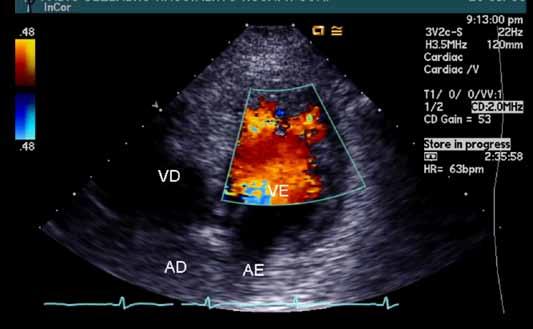 Fig. 1 - Ecocardiograma, imagem apical quatro câmaras, demonstrando trabeculações e recessos intertrabeculares no ventrículo esquerdo. Pelo Doppler colorido se verifica o fluxo nas trabéculas.