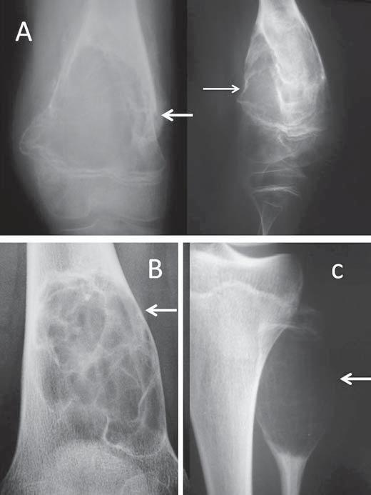 Figura 2. Radiografia simples de joelho esquerdo em anteroposterior (A) e perfil (B) de um indivíduo adulto com dor mecânica no joelho.