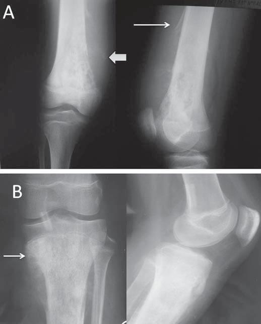 Figura 3. Radiografia simples do joelho esquerdo em anteroposterior (A) e perfil (B) de paciente do sexo feminino portadora de lúpus eritematoso sistêmico com dor articular.
