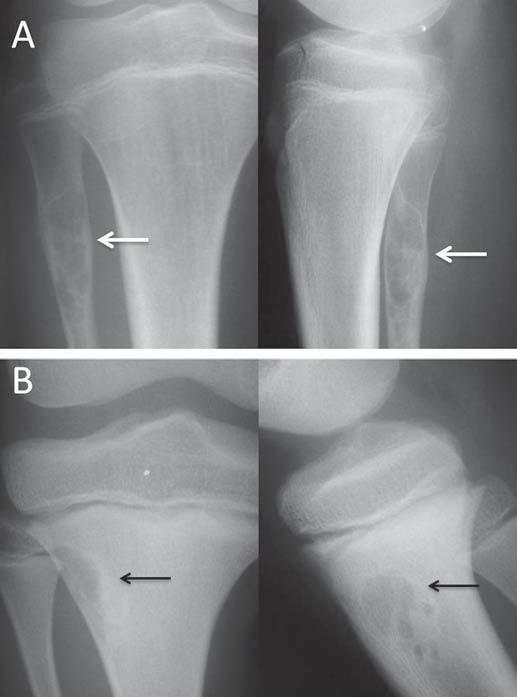 Figura 12. A: Radiografia simples de joelho direito em anteroposterior e perfil de adolescente que sofreu trauma direto na região do joelho.