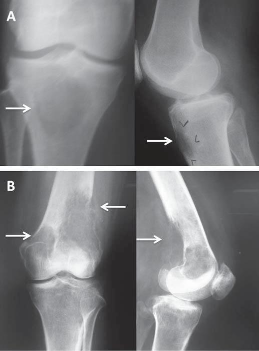 Lesão indolor, compatível com fibroma não ossificante.