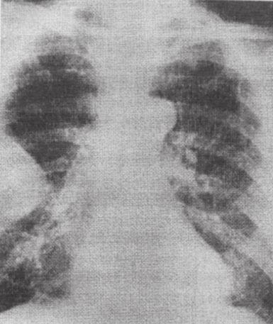 5. Tomografia computadorizada do tórax: Tumor de parede costal à direita invadindo o 5 o arco costal (destruindo-o); pleura e pulmão