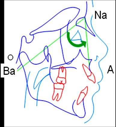 34 c) Comprimento efetivo da maxila (Co-A): comprimento da maxila e da mandíbula: é obtido pela distância linear entre os pontos Condílio e o ponto A, como demonstrado na Figura 6 abaixo: Figura 6: