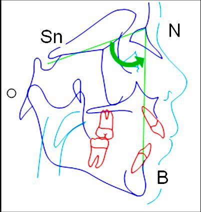 35 4.2.2.2.4 Componentes da Mandíbula a) SNB (idealizado por Reidel): é o ângulo formado pelas linhas SN e NB (Figura 8), que define a relação ântero-posterior da mandíbula em relação à base do crânio.