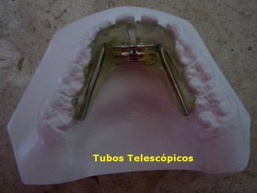 ). 4.2.4 Método Estatístico Figura 25: Tubos Telescópicos Comparativos entre grandezas cefalométricas de 29 indivíduos portadores de má oclusão Classe II e que se submeteram ao uso dos SN1.