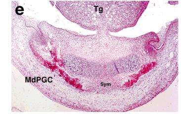 placa que abraço o nervo trigeminal 9