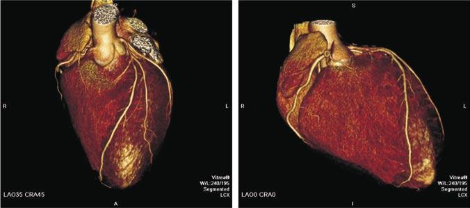 Nomura CH, et al. Tomografia de coronárias: indicações clínicas e perspectivas futuras liando no planejamento clínico e terapêutico mais adequado 1,2.