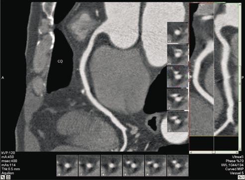 Rev bras ecocardiogr imagem cardiovasc 2011, 24(1):76-87 Angiotomografia A maior resolução dos protocolos de aquisição de imagem, combinada com a injeção intravenosa de contraste e a TCMD, permitiu a