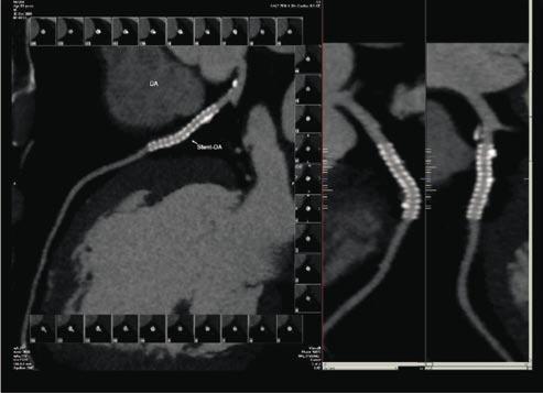 Rev bras ecocardiogr imagem cardiovasc 2011, 24(1):76-87 tificar a placa não calcificada em fibrosa ou rica em lipídeos.