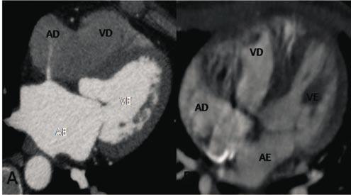 Nomura CH, et al. Tomografia de coronárias: indicações clínicas e perspectivas futuras Malformações cardíacas congênitas.