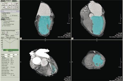 A medida da função ventricular esquerda regional é baseada na utilização do espessamento sistólico, usado no modelo de 17 segmentos da American Heart Association.