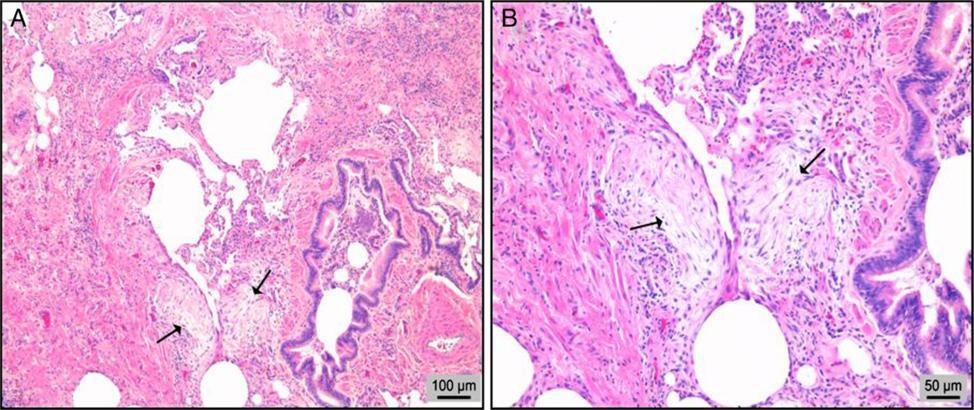 Figura 4. Histologia de amostra obtida por biópsia pulmonar cirúrgica. Histologia de UIP, que inclui fibrose densa, focos fibroblásticos (setas) e apenas algumas paredes alveolares normais (no meio).