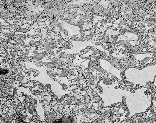 Histologicamente há dano alveolar difuso, com espessamento da parede dos alvéolos por inflamação e proliferação do tecido conjuntivo, pneumócitos II e membranas