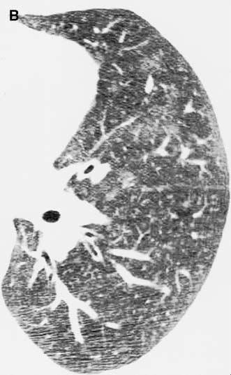 periférico da parede dos brônquios (Figura 11). O enfisema centrolobular nos lobos superiores é comum. As lesões podem reverter com a cessação tabágica.