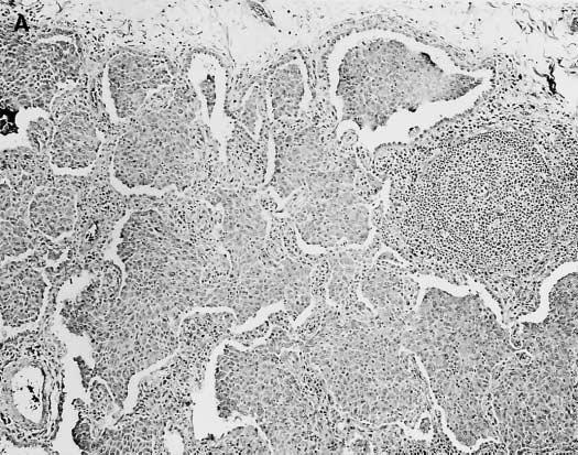 As paredes alveolares estão moderadamente espessadas por tecido conjuntivo fibroso e algumas células de inflamação crónica. Os espaços alveolares estão preenchidos por macrófagos (2). [8] 9.4.6.