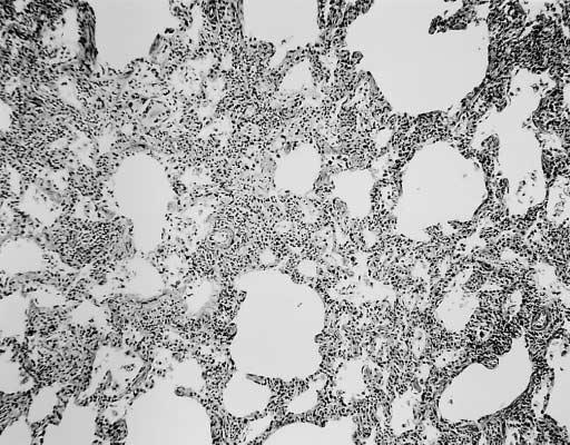 Histologicamente apresenta infiltração intersticial difusa de linfócitos T, macrófagos e células plasmáticas, com hiperplasia das células tipo II e ligeiro aumento dos macrófagos alveolares.