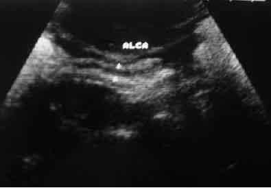 Imagem ultrassonográfica, realizada com transdutor de 3,75MHz, de cão filhote da raça Beagle, do tratamento com probiótico 2 (Lactobacillus), com mensuração da espessura e avaliação morfológica das