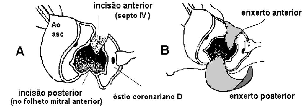 a ser implantada. A Figura 1B mostra os enxertos posicionados, previamente ao implante da prótese aórtica.