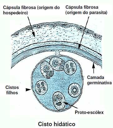 CISTO HIDÁTICO Forma arredondada e dimensões variadas. Infecções recentes tamanho: 1mm. Meses depois tamanho: vários centímetros.